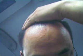 自己責任で行うAGA治療