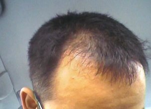 自己責任で行うAGA治療