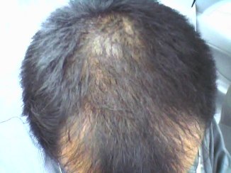 自己責任で行うAGA治療