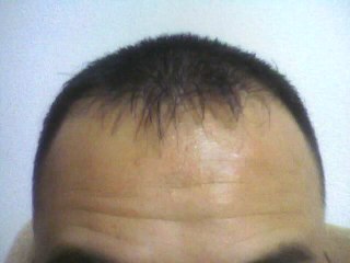 自己責任で行うAGA治療