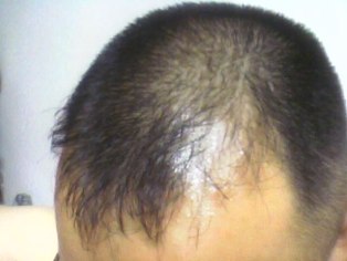 自己責任で行うAGA治療