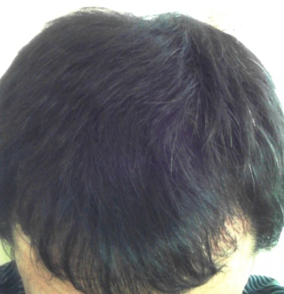 自己責任で行うAGA治療