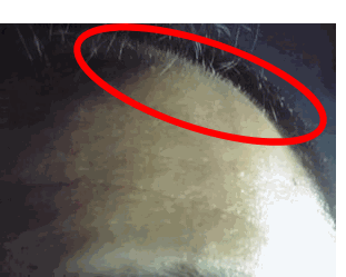 自己責任で行うAGA治療